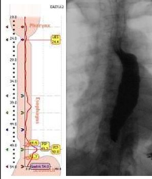 Esophageal Manometry and Barium